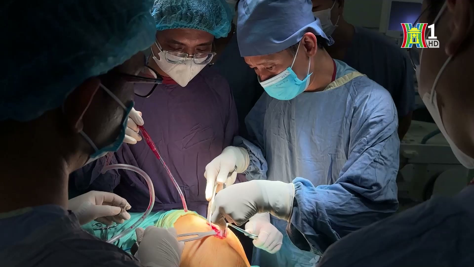 Thay khớp nhân tạo cho người cao tuổi | Sức khỏe cộng đồng | 12/04/2025